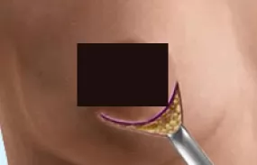 Before and after pictures of breast augmentation with an areola incision